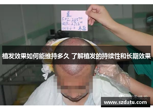 植发效果如何能维持多久 了解植发的持续性和长期效果 植发效果如何能维持多久 了解植发的持续性和长期效果
